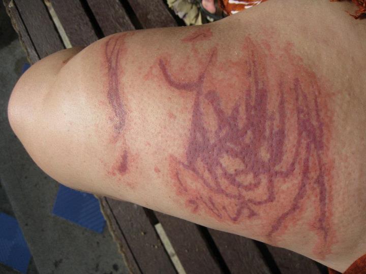 First Aid: Jellyfish Sting (Red Cross/Crescent)