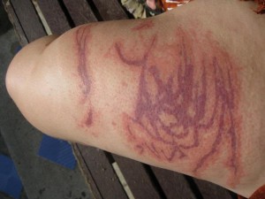 Jelly Fish Stings
